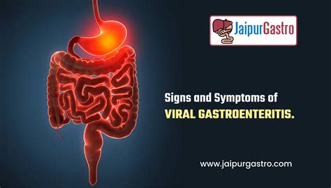 Gastroenteritis .